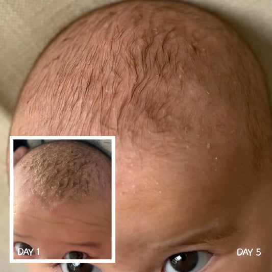 Before and after comparison of cradle cap on baby scalp treated with MooGoo Scalp Repair Cream