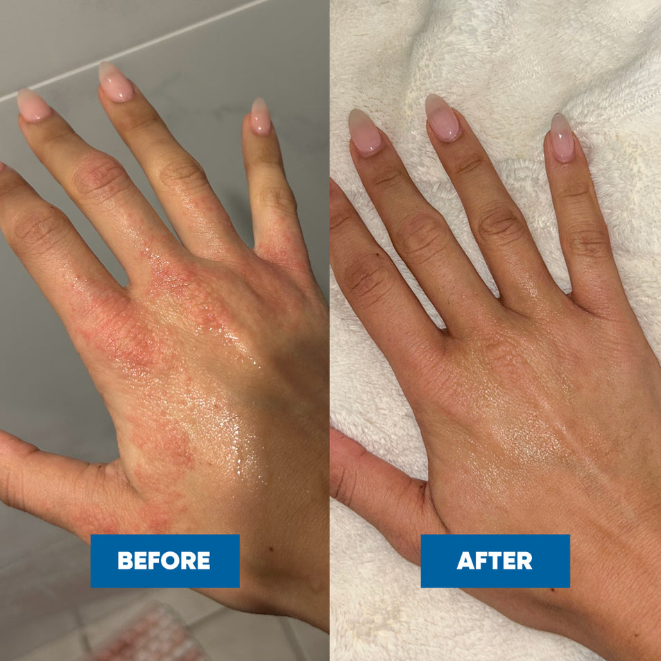 Before and after comparison of a a woman's hand with visible patches of Eczema, showing an amazing transformation after using the MooGoo Scalp Cream.