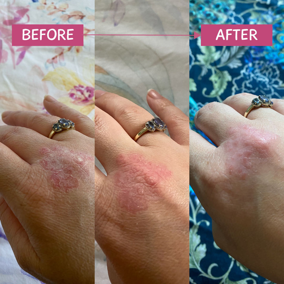 Before and after comparison of a hand with a ring, showing Eczema skin condition improvement after using the MooGoo Pink Eczema Cream.