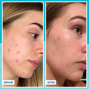 Before and after comparison of a woman's face with acne and without acne after using MooGoo Tamanu Oil - reduce scars, stretch marks and blemishes. 
