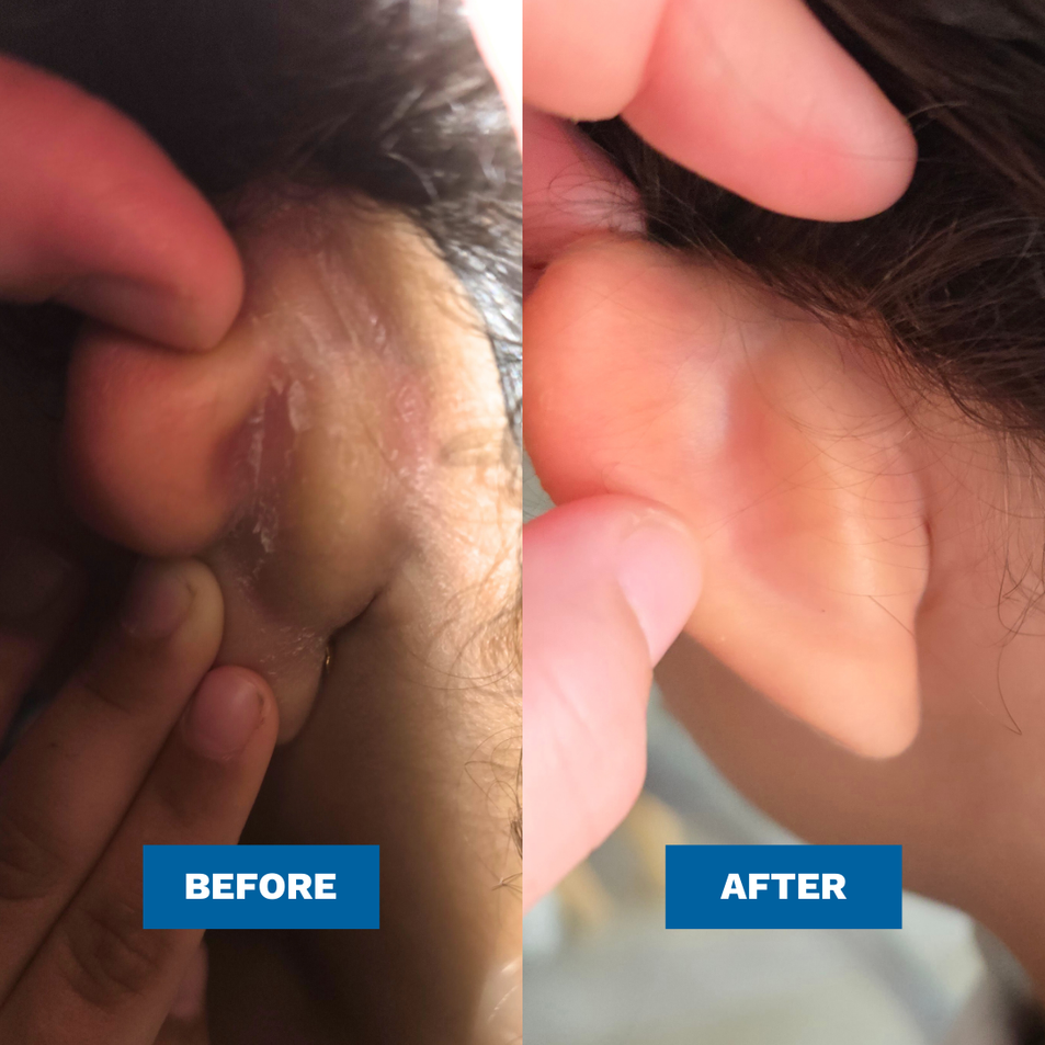Before and after comparison of a girl's ear with visible improvements from Eczema after using the MooGoo Pink Eczema Cream.